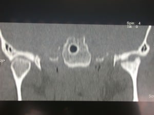 Artrosi dell'Articolazione Temporo-Mandibolare