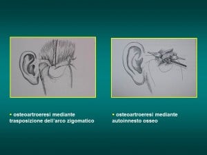 trattamento chirurgico Lussazioni ATM