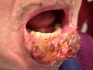 carcinoma-labbro