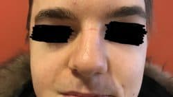 Lipofilling Viso -post