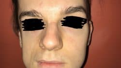 Lipofilling Viso -post