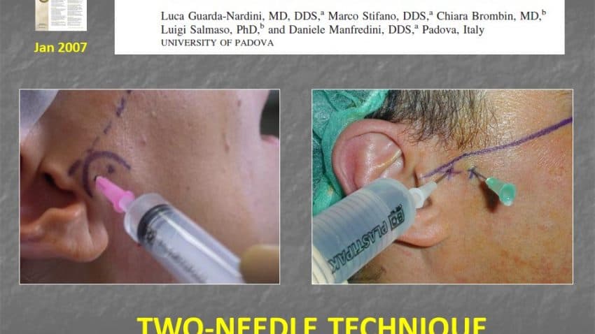 Artrocentesi Articolazione Mandibolare