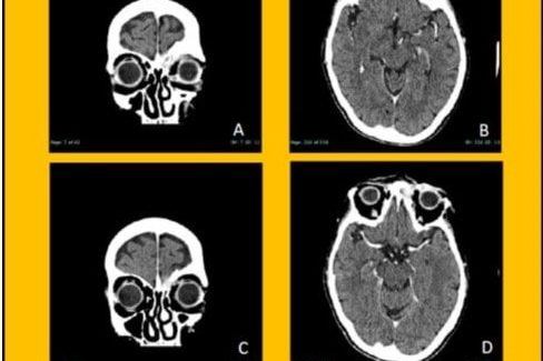 Immagine MASSA ORBITARIA IgG4 MEDIATA -3