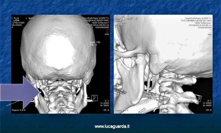 Si Può Convivere Con La Sindrome Di Eagle