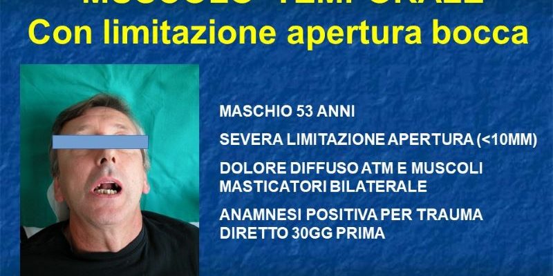 fibrotozzazione muscolo temporale