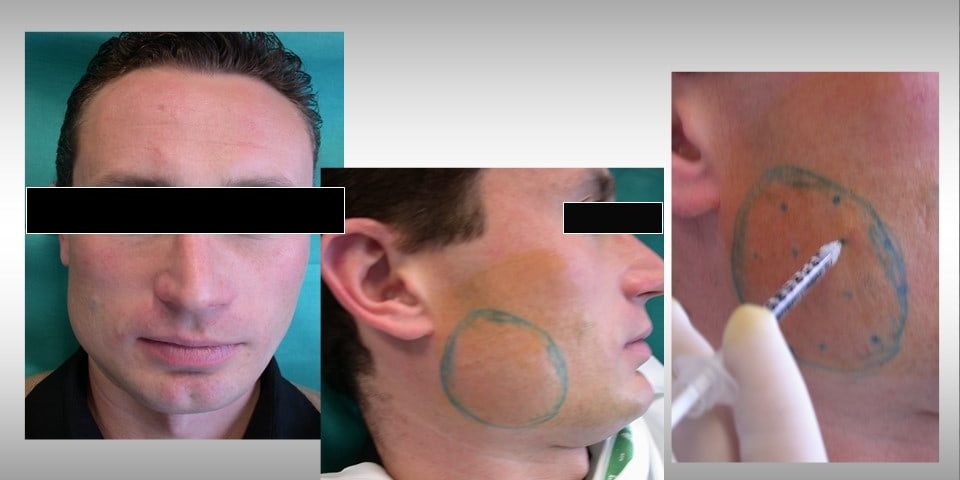 1 ipertrofia masseterina