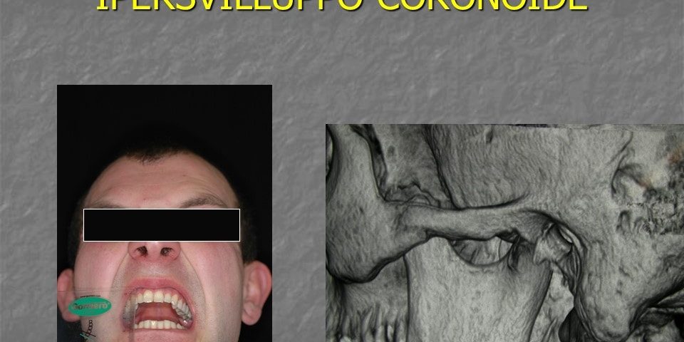 2 ipersviluppo coronoide