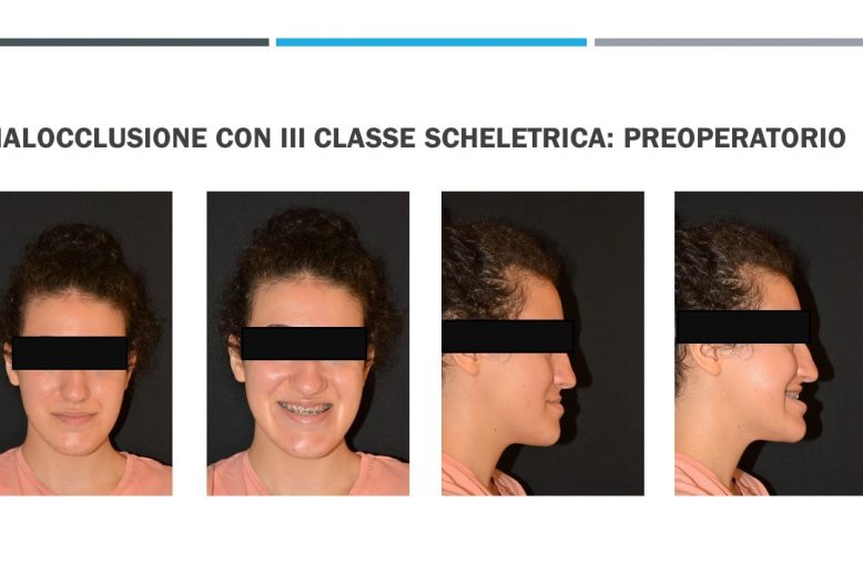 malocclusione terza classe scheletrica