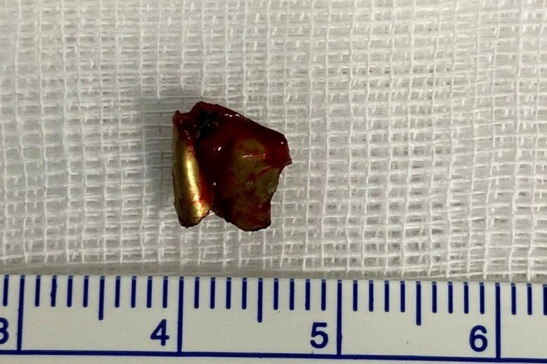 Maxillo-facciale-treviso-proiettile-occhio