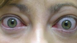 disturbi orbito-palpebrali