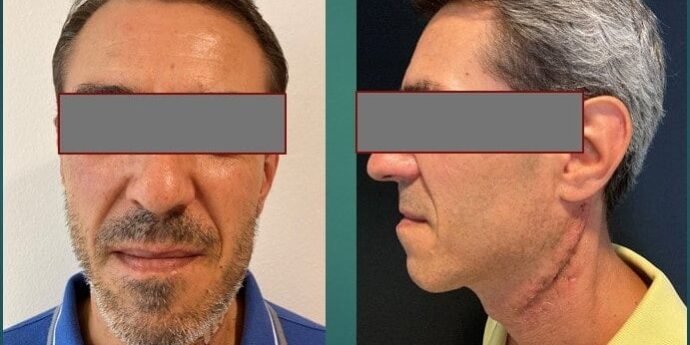 eagle-esterno-controllo-a-due-settimane