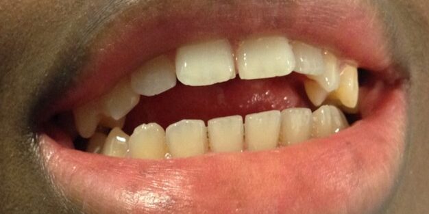 limitata apertura bocca