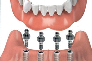 guarda impianti dentali