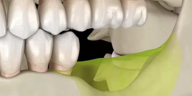 innesto osseo mandibola