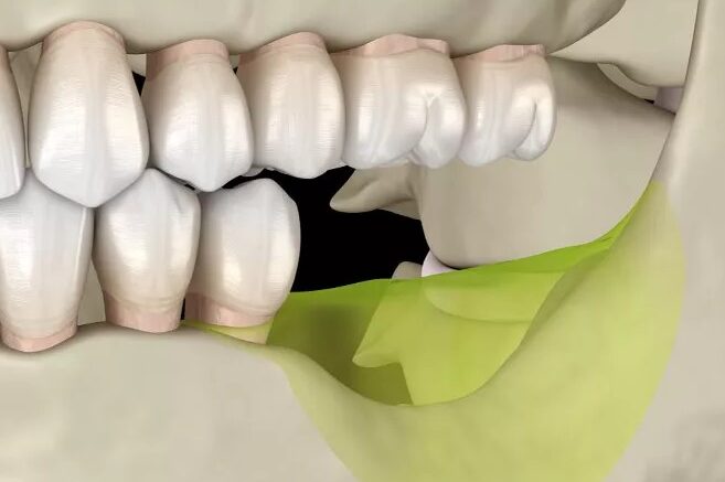 innesto osseo mandibola