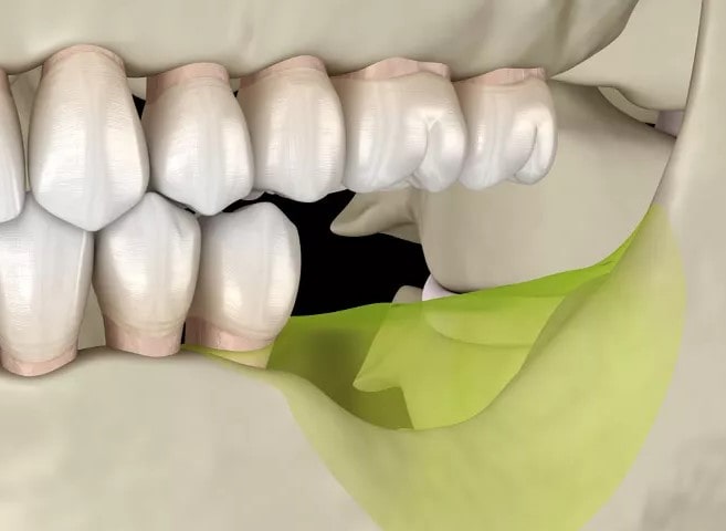 Modello di mascella inferiore dentale modello di pratica dell'impianto mandibolare modello di pratica educativa del dentista 66 Modello di mascella inferiore dentale modello di pratica dell'impianto mandibolare modello di pratica educativa del dentista 66