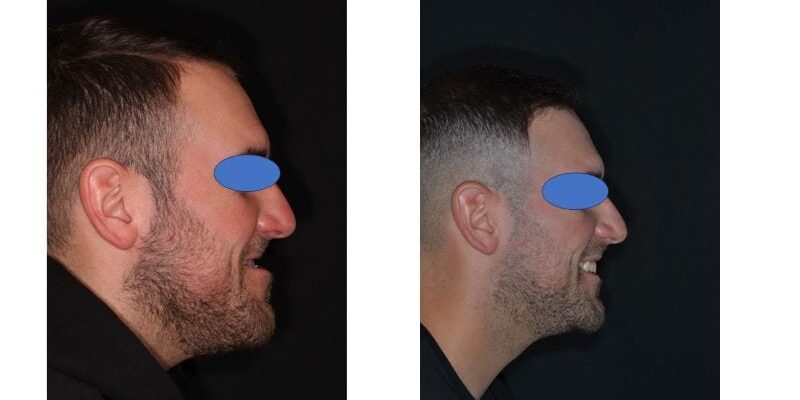 ipersviluppo mandibolare2