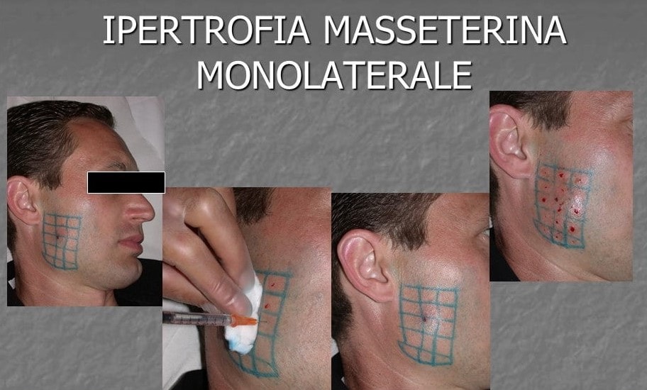 https://www.lucaguarda.it/wp-content/uploads/2023/11/ipertrofia-masseterina-monolaterale.jpg