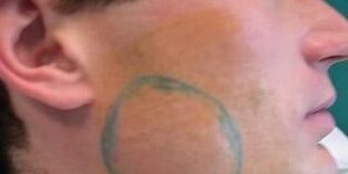 ipertrofia-masseterina-piccola