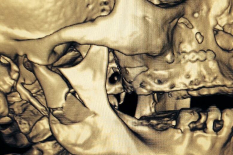 foto mandibola frattura scomposta.jpg