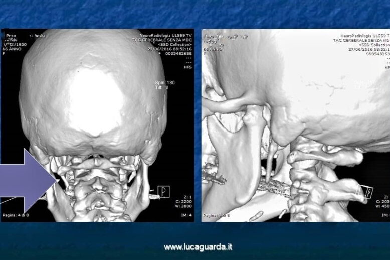 radiografia2 – sindrome di eagle