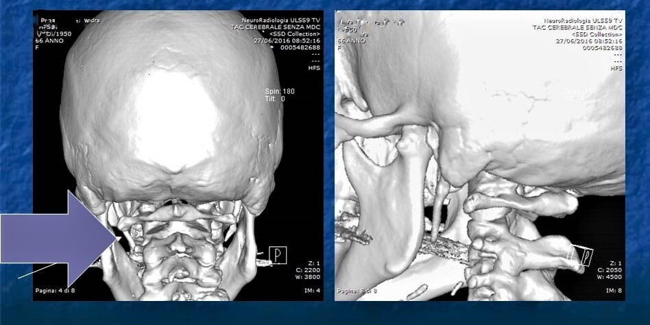 radiografia2 – sindrome di eagle