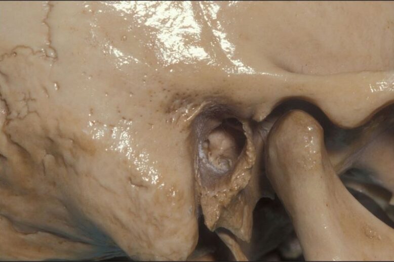 atm2 – condilo mandibolare