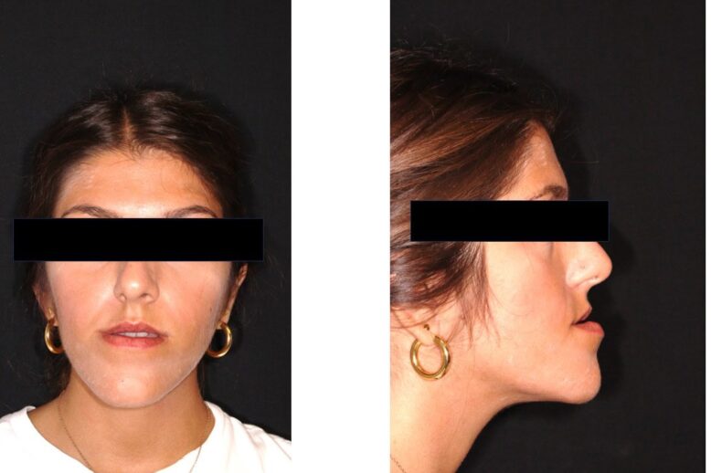 terzo grado schelettrico