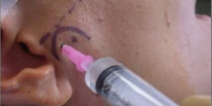 artrocentesi-aritcolazione-temporo-madibolare