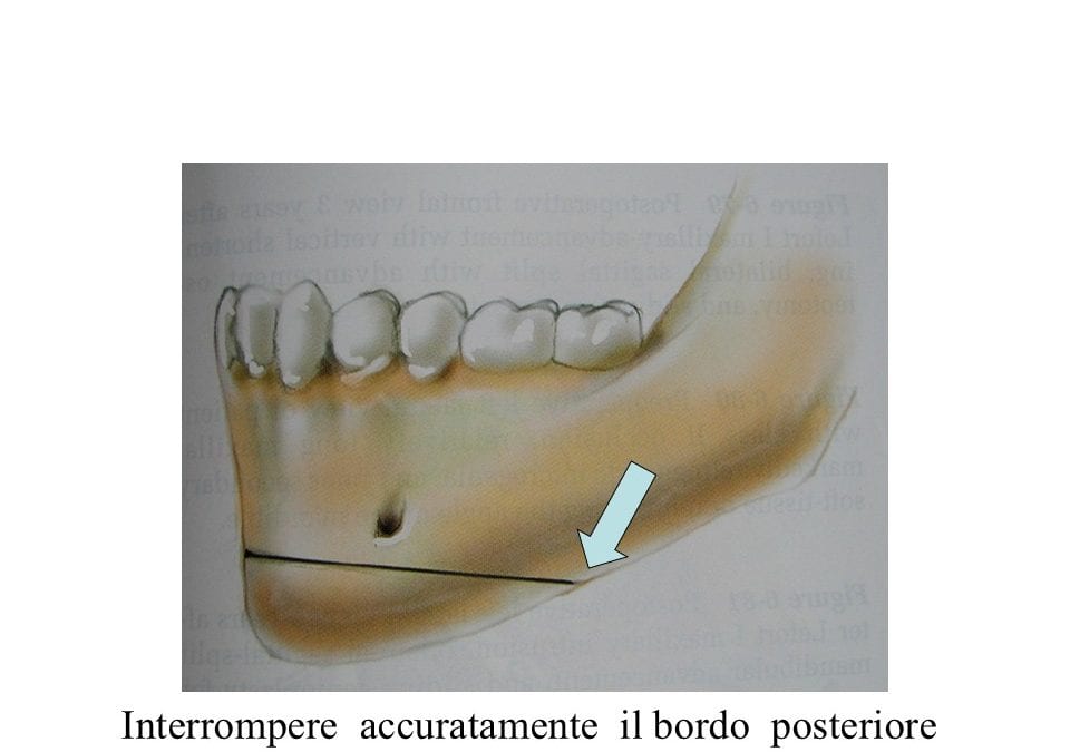 mentoplastica - addittiva e riduttiva